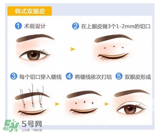 割雙眼皮有幾種做法？雙眼皮有哪幾種形狀？