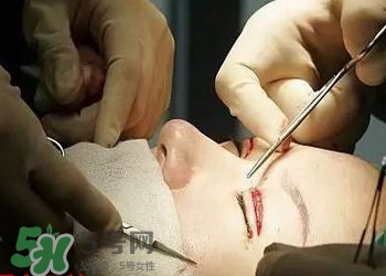 割雙眼皮疼不疼？割雙眼皮疼幾天能好？