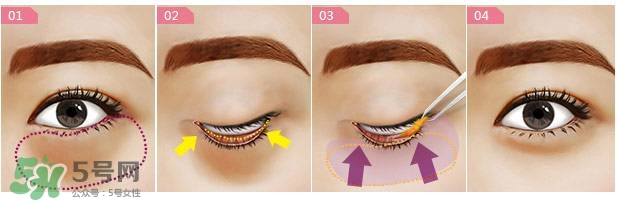 眼袋是怎么形成的？手術(shù)去眼袋安全嗎