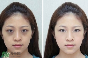 臥蠶是黑眼圈嗎？臥蠶和黑眼圈的區(qū)別