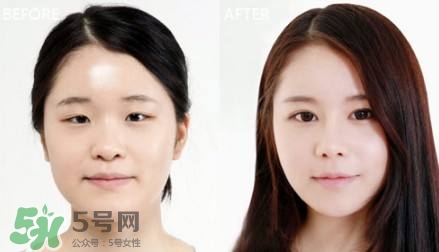 割雙眼皮有什么后遺癥嗎？割雙眼皮有什么危害性？