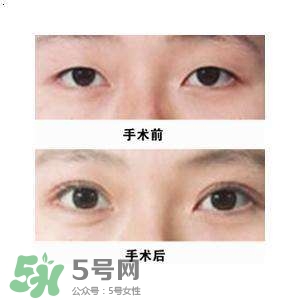 割雙眼皮疼不疼？割雙眼皮疼幾天能好？