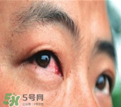 紅眼病是怎么引起的？紅眼病怎么產(chǎn)生的