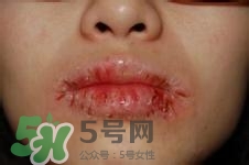 嘴唇干燥是什么原因？嘴唇干裂脫皮怎么辦？