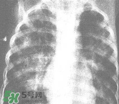 紅眼病是怎么引起的？紅眼病怎么產(chǎn)生的