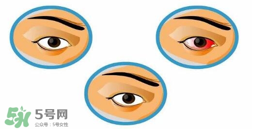 紅眼病用什么眼藥水好？紅眼病吃什么好得快