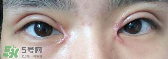 眼角增生是什么意思？眼角增生了怎么辦？