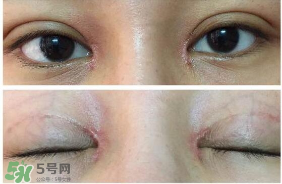 眼角增生是什么意思？眼角增生了怎么辦？