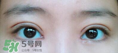 眼角增生會(huì)自動(dòng)恢復(fù)嗎？眼角增生多久可以下去？