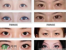 哪些人需要開眼角？需要開眼角的眼睛圖片