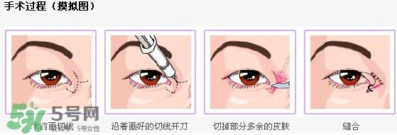 哪些人需要開眼角？需要開眼角的眼睛圖片