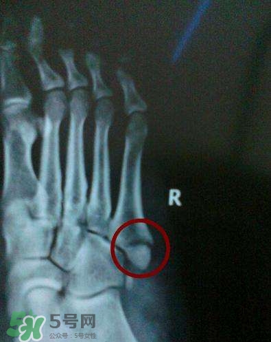 骨裂吃什么好得快？骨裂和骨折的區(qū)別