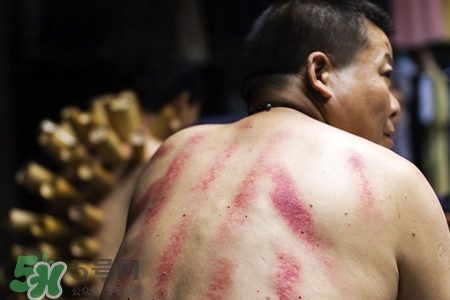 骨質(zhì)疏松可以刮痧嗎？骨質(zhì)疏松刮痧好嗎？