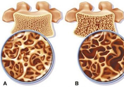 骨質(zhì)疏松要補鈣嗎？骨質(zhì)疏松補什么好？
