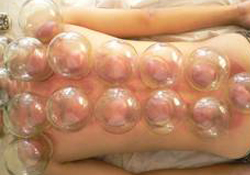 拔火罐有依賴性嗎？拔火罐依賴性強(qiáng)嗎？