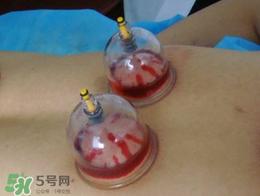 春天可以拔火罐嗎？春天適合拔火罐嗎？