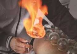 春天可以拔火罐嗎？春天適合拔火罐嗎？