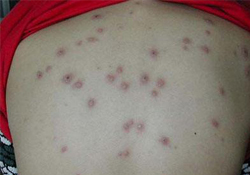 水痘會發(fā)燒嗎？小孩出水痘發(fā)燒怎么辦？