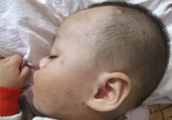 有水痘的寶寶能不能沾水？長(zhǎng)水痘可以碰水嗎？