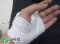 傷口化膿怎么處理？傷口化膿用什么藥好？