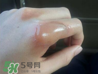 燙傷可以用牙膏嗎？燙傷用牙膏管用嗎？