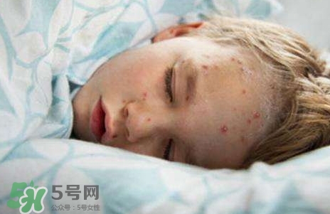 長水痘可以吃雞蛋嗎?得水痘能吃雞蛋嗎? 長水痘可以吃雞蛋嗎?得水痘能吃雞蛋嗎?