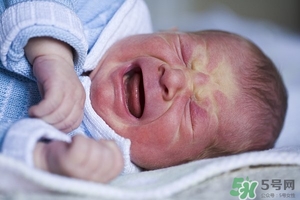 病理性黃疸孩子有何癥狀 病理性黃疸的特點 病理性黃疸孩子有何癥狀 病理性黃疸的特點