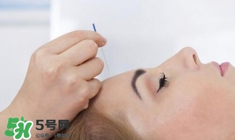 叢集性頭痛會死人嗎？叢集性頭痛的特點(diǎn)