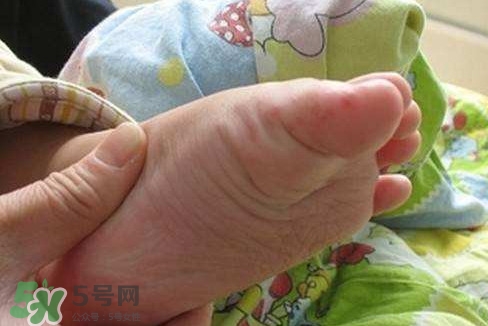 手足口病如何預(yù)防？手足口病怎樣預(yù)防