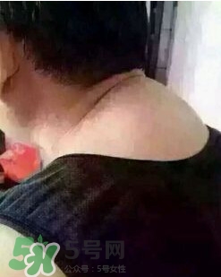 刮痧之后可以艾灸嗎？刮痧之后可不可以艾灸