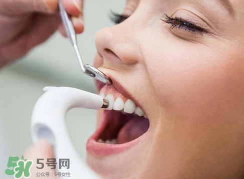 洗牙要多久洗一次?洗牙一般隔多久洗一次? 洗牙要多久洗一次?洗牙一般隔多久洗一次?