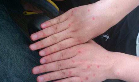 身上紅疙瘩是什么？身上紅疙瘩不痛不癢