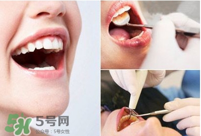 如何去掉牙結(jié)石？牙結(jié)石怎么去除