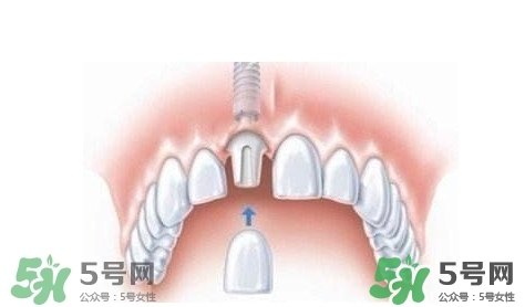 牙周炎能種植牙嗎？牙周炎能不能種植牙