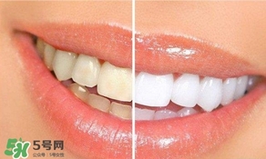 牙周炎好治嗎？牙周炎好不好治