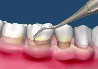 牙周炎怎么治療效果最好？牙周炎怎么治療小偏方