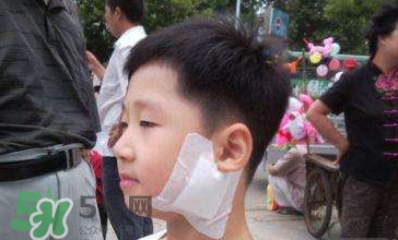 流行性腮腺炎怎么預(yù)防？流行性腮腺炎如何有效預(yù)防