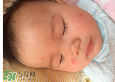 嬰兒蚊子咬了怎么消腫？嬰兒蚊子咬了怎么消腫止癢最快？