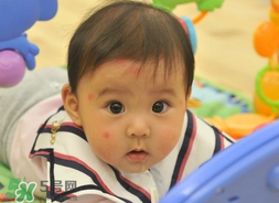 嬰兒被蚊子咬了如何去紅點(diǎn)？被蚊子咬后紅點(diǎn)如何去除？