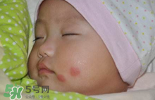 嬰兒被蚊子咬了如何去紅點(diǎn)？被蚊子咬后紅點(diǎn)如何去除？