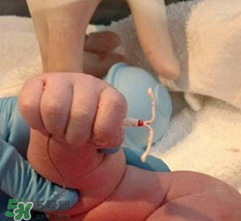 新生兒手握避孕環(huán)出生是怎么回事？出生后健康嗎？