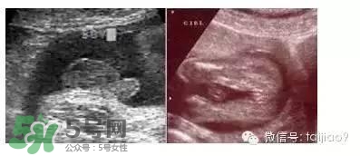 B超單數(shù)據(jù)怎么看男女？B超單看男女準(zhǔn)嗎？