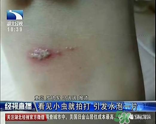 隱翅蟲(chóng)有毒嗎？隱翅蟲(chóng)會(huì)毀容嗎？