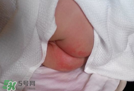 尿布疹怎么辦？寶寶尿布疹擦什么藥好？