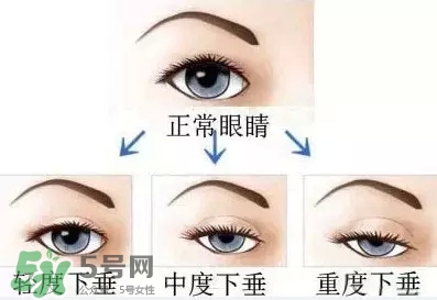 長(zhǎng)期用假睫毛雙眼皮貼對(duì)眼睛有什么傷害？