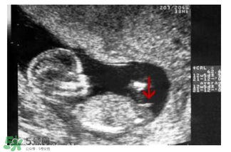 NT超圖全景看寶寶性別，親證有效的B超自測男女方法