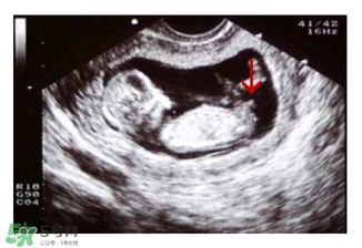 NT超圖全景看寶寶性別，親證有效的B超自測男女方法