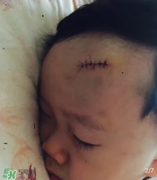 日本msd祛疤膏是抗生素嗎？日本msd祛疤膏是不是抗生素？