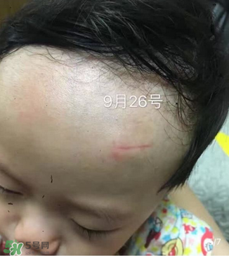 日本msd祛疤膏是抗生素嗎？日本msd祛疤膏是不是抗生素？