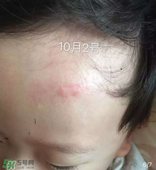 日本msd祛疤膏是抗生素嗎？日本msd祛疤膏是不是抗生素？